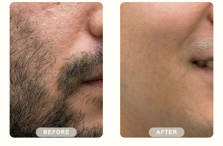 Before and after — men's beard and cheek, stubble cleared with SHR