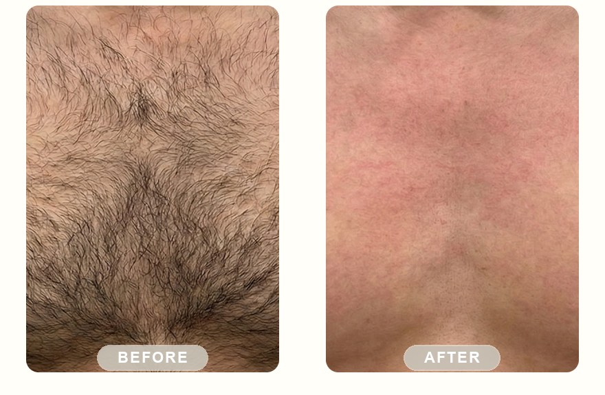 Before and after — men's chest hair cleared with SHR