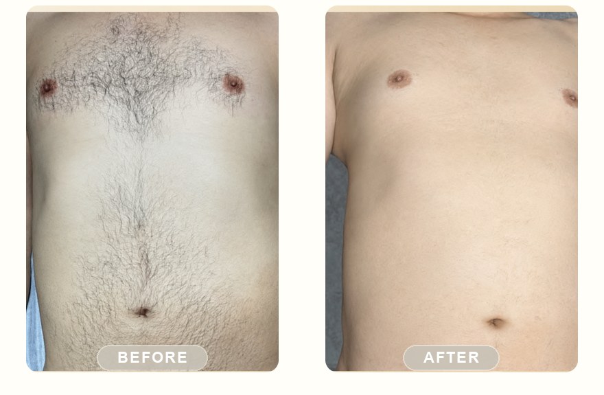 Before and after — men's chest and stomach hair cleared with SHR
