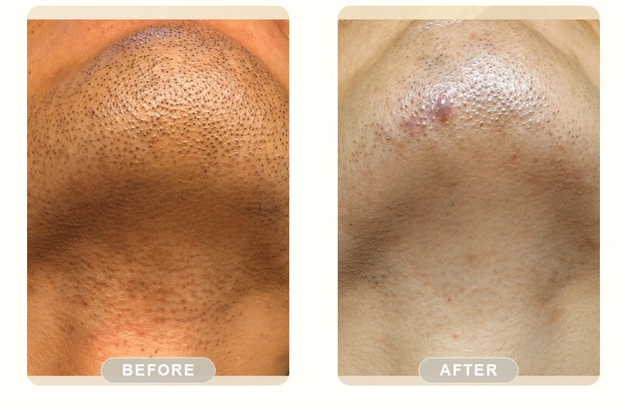 Before and after — men's chin, stubble cleared with SHR