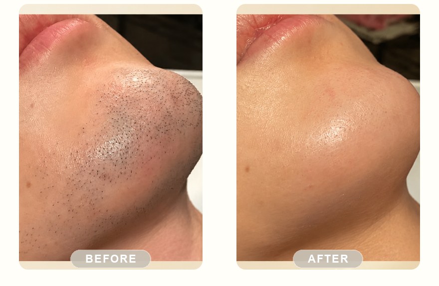 Before and after — men's jaw and neck, stubble cleared with SHR