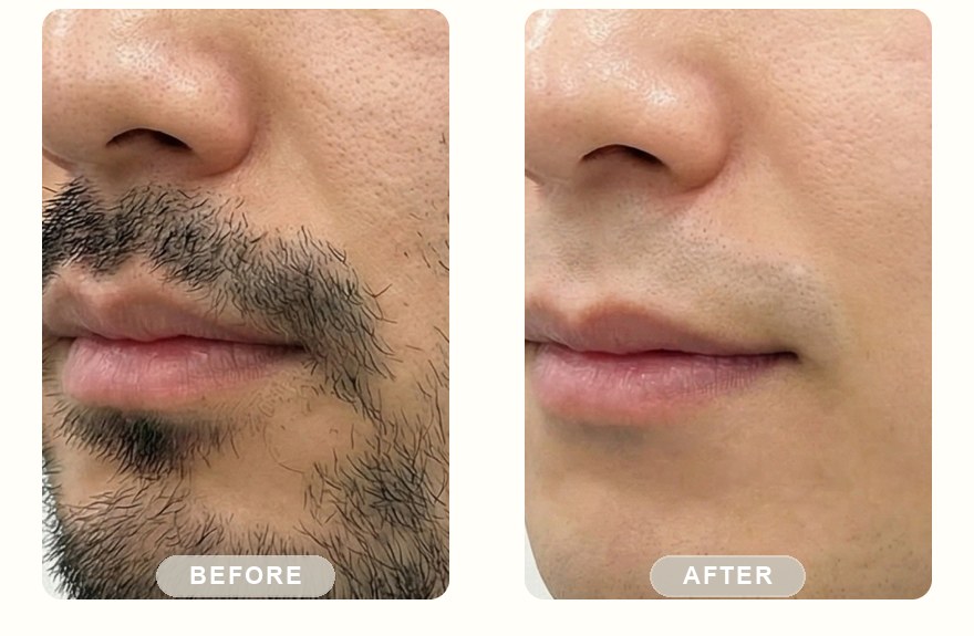 Before and after — men's mustache and chin, smoother look with SHR