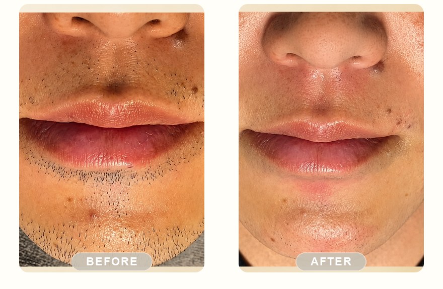 Before and after — men's upper lip and mustache, stubble cleared with SHR