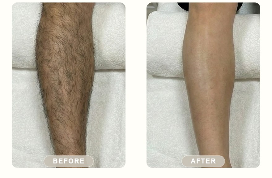 Before and after — men's lower leg hair removal with SHR