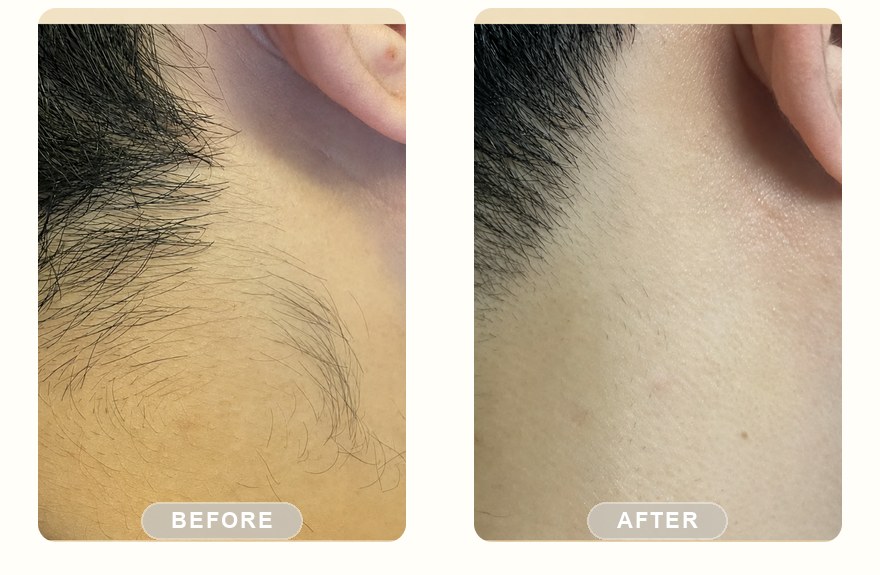 Before and after — men's sideburn and neckline shaped with SHR