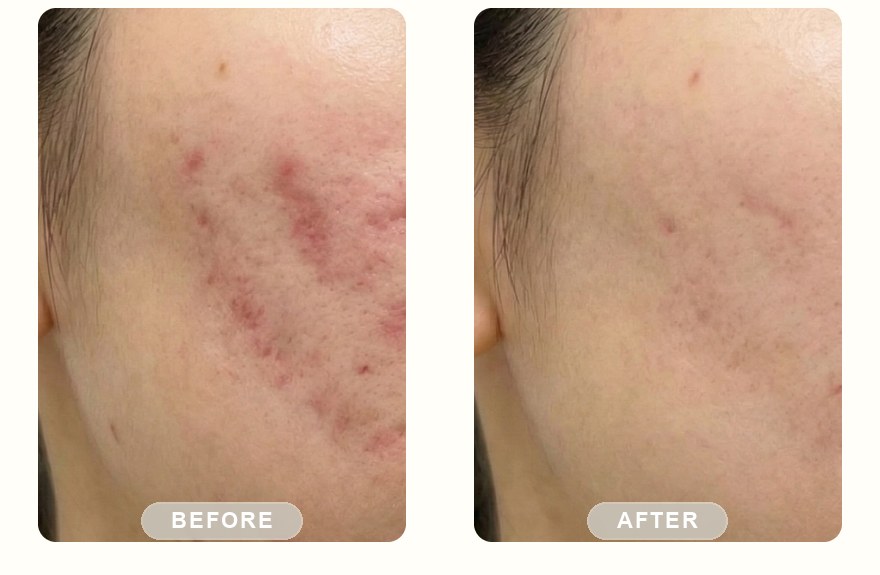 Before and after — IPL photofacial, calmer acne-prone skin