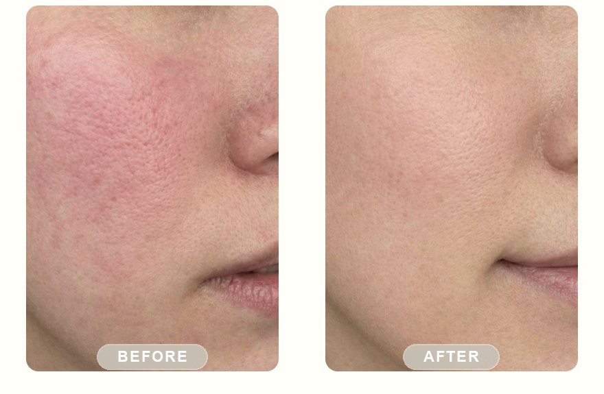 Before and after — IPL photofacial, refined pores and glow