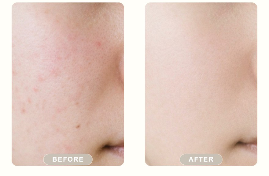 Before and after — IPL photofacial, refined, more even-looking skin