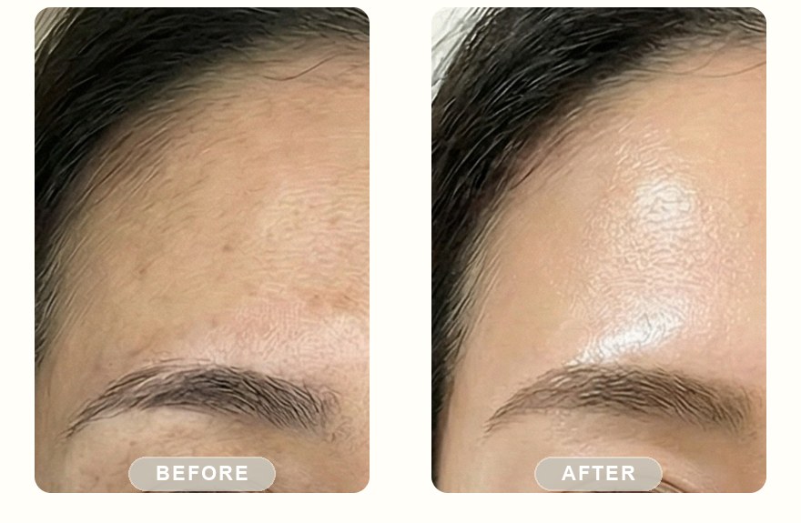 Before and after — IPL photofacial, smoother forehead texture