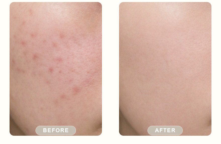 Before and after — IPL photofacial, blemish marks faded