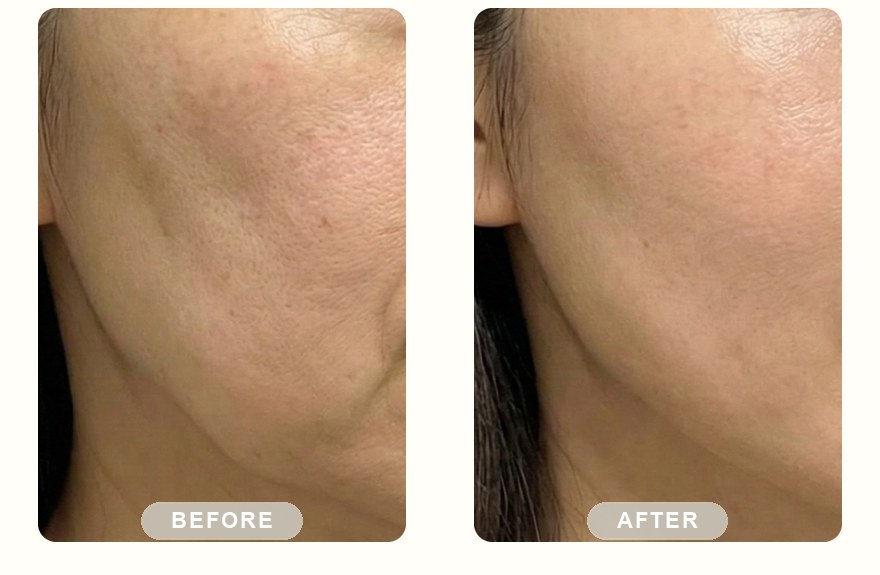 Before and after — IPL photofacial, more even pigment