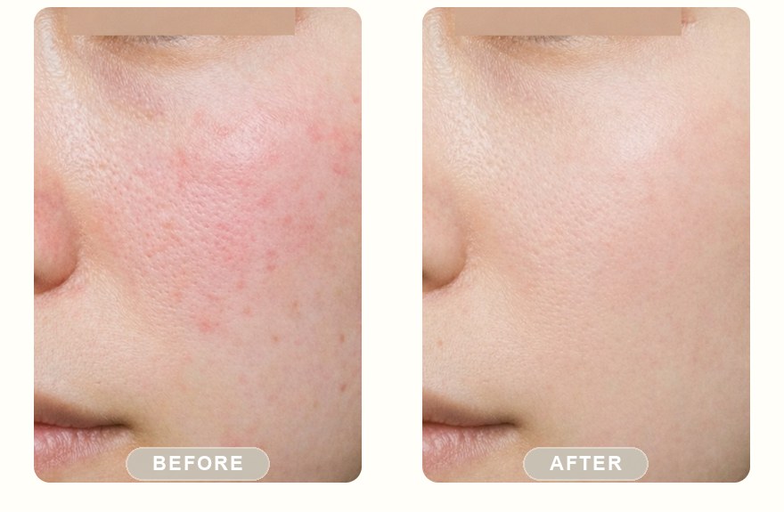 Before and after — IPL photofacial, calmer redness
