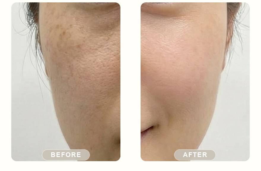 Before and after — IPL photofacial, dark spots more even