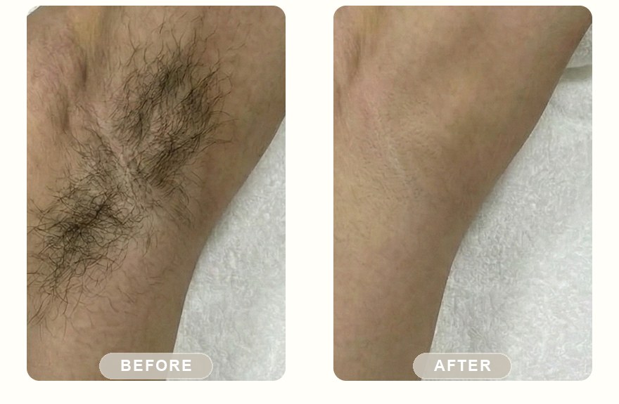 Before and after — men's underarm hair reduced with SHR