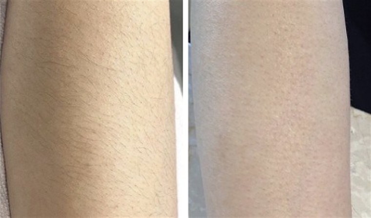 Before and after — legs smoother with IPL/SHR
