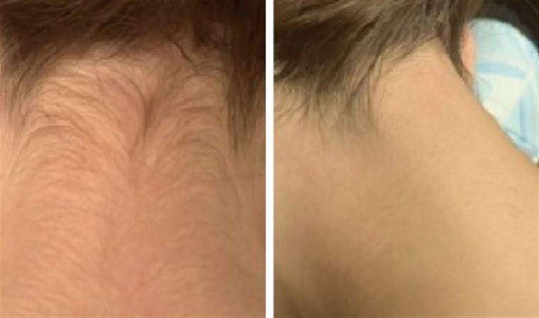 Before and after — nape and hairline tidied with IPL/SHR