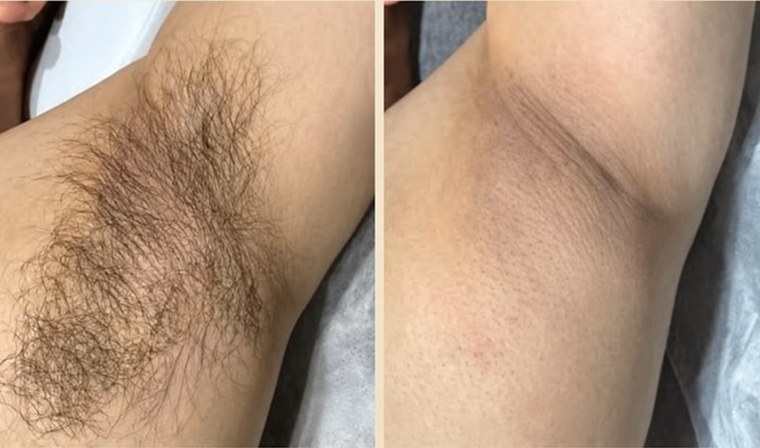Before and after — underarm hair noticeably reduced with IPL/SHR