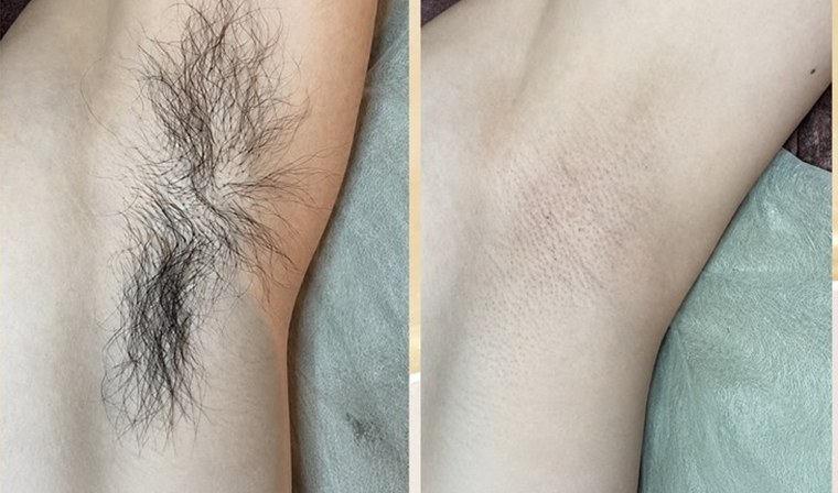 Before and after — underarm hair cleared with IPL/SHR